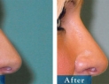 Edmonton &amp; Area Cosmetic Rhinoplasty Surgery 