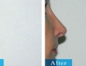 Edmonton &amp; Area Structural Rhinoplasty Surgery 