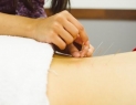 Medical Acupuncture