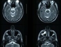 Brain MRI