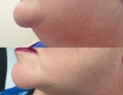 Lips Dermal Filler